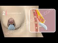How Breast Lifting Operation Is Performed 3D Animation Doç Dr Guncel Ozturk DRGO