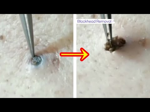 Big Blackhead removal Video #8 #Blackheads #blackheadsremoval #sebum