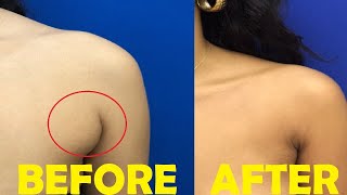 how to get rid of armpit fat in 3 minutes