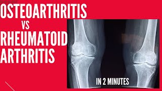 Osteoarthritis vs Rheumatoid arthritis in 2 mins!