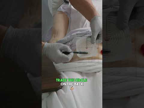 Colostomy Bag