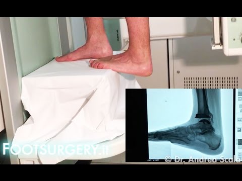 Come far fronte con un mal di testa in osteocondrosi Può essere passo osteocondrosi