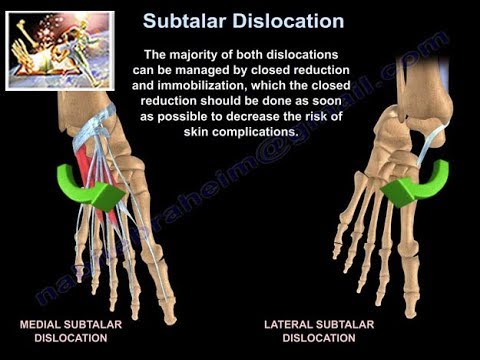 Subtalar Dislocation - Everything You Need To Know - Dr. Nabil Ebraheim - YouTube