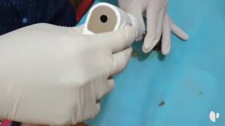 CirCurer, un nuevo dispositivo para la cirugía de la fimosis