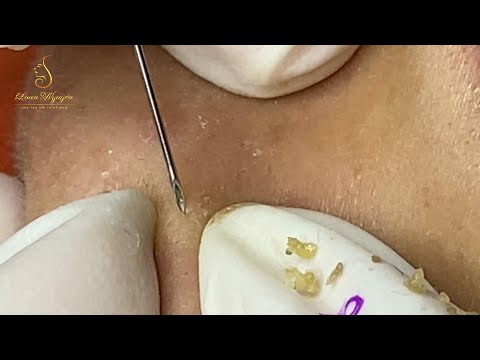 Loan Nguyen Acne Treatment (#129)
