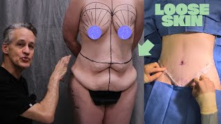 Removing Loose Skin After 150 lb Weight Loss (Lower Body Lift)