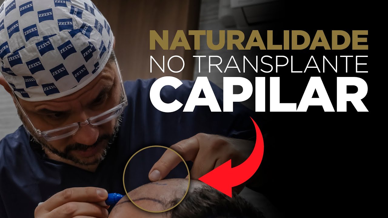 Transplante capilar: como garantir um resultado natural