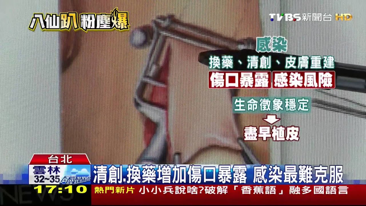 呼吸窘迫、腎衰竭、敗血症 塵爆傷者難關