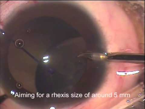 Management of Subluxated lens in children using Cionni ring (ECR)