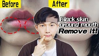 Easy solution for the 《Skin around your Mouth turned Black》！