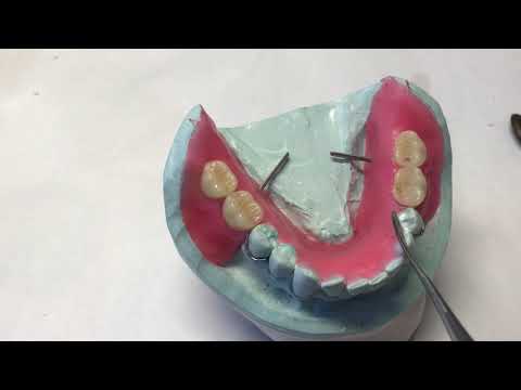 Laboratory procedures for fabrication of an acrylic based removable partial denture.