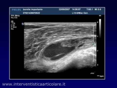 Apparecchi per il trattamento della colonna vertebrale e cappe Come bere gelatina nelle malattie delle articolazioni