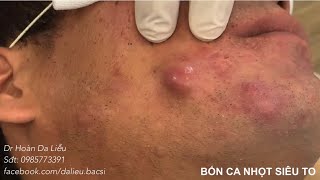 Bốn ca nhọt siêu to|Dermatologist treating squeeze big pimples, whitehead blackhead, pustule,