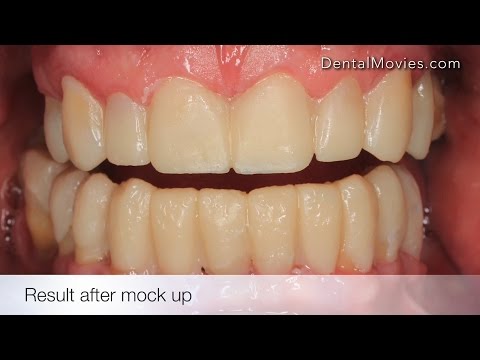 Wax up and mock up. Treatment Planning. Dr. Bartosz Matejkowski