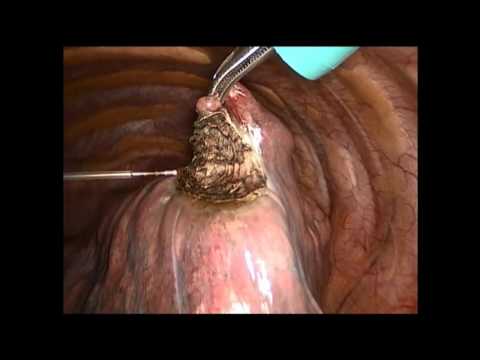 Limax® 120 – VATS Metastasectomy 2