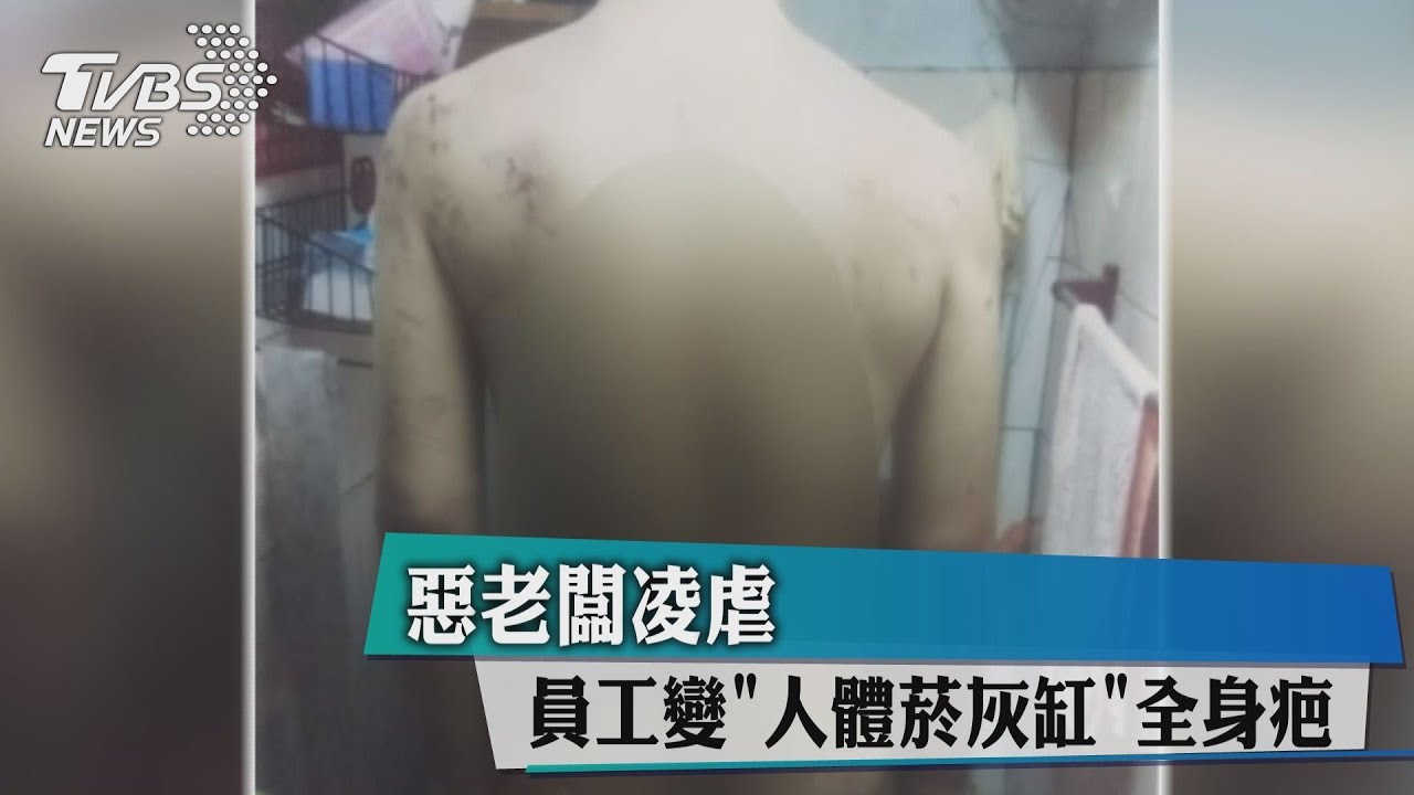 惡老闆凌虐 員工變「人體菸灰缸」全身疤
