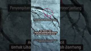Download lagu Kateter Jantung dengan Alat Canggih Ini  #drv #kateter #jantung #pembuluhdarah #ring #ivus mp3