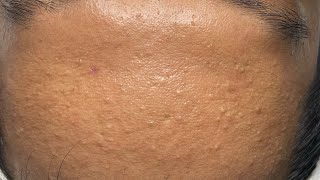 Satisfying Pimple Extraction – One by One 640 P2