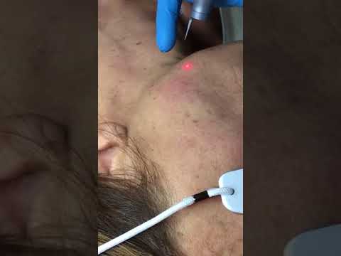 La decolorazione di crema da shiseido La minipolitica di una lentiggine 2 in Kaluga