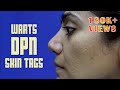Know How To Get Rid Of WARTS, SKIN TAGS And FRECKLES | Dr Apratim Goel