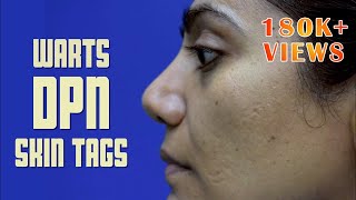 Know How To Get Rid Of WARTS, SKIN TAGS And FRECKLES | Dr Apratim Goel