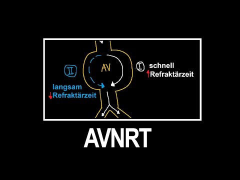 AV-Knoten Reentry Tachykardie (AVNRT) einfach erklärt