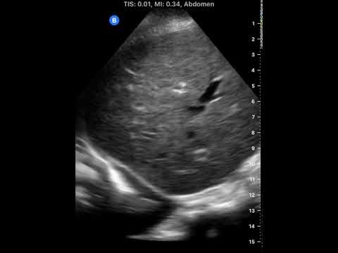 Right Pleural Effusion | Clinical Image