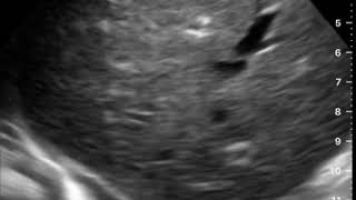Right Pleural Effusion | Clinical Image