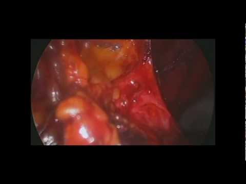 Obiettivo massaggio prostatico Limaging della vescica e della prostata