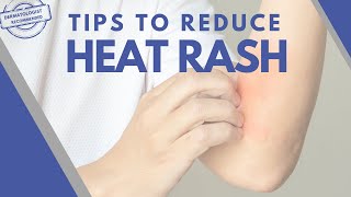 10 tips to Prickly/Heat Rash: Dermatologist Guide