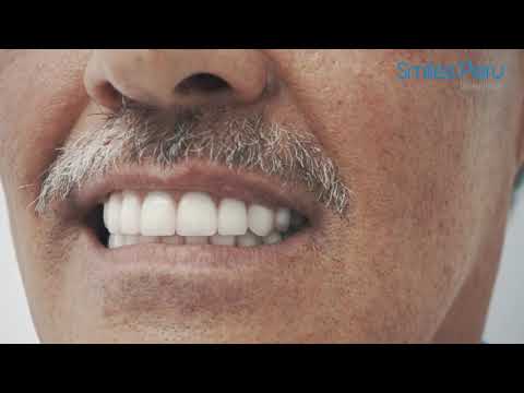 Implante Dental Peru | Prótesis sobre Implantes Dentales | Smiles Peru