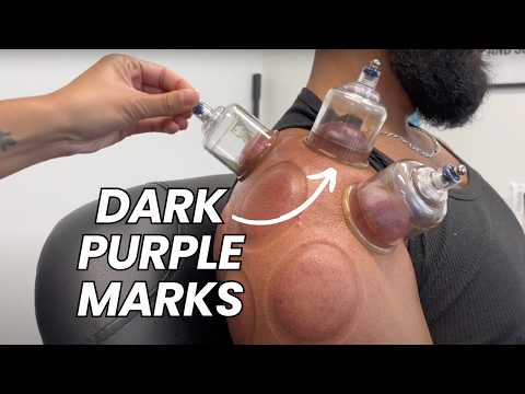 Cupping Therapy for Shoulder Pain - What to Expect