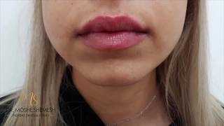 פיסול שפתיים, עיבוי שפתיים - לפני ואחרי - דר' משה שמש