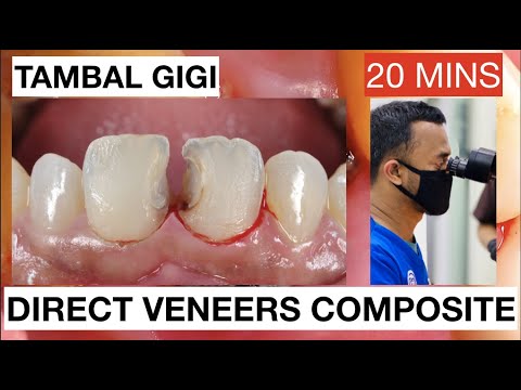 Step by Step Direct Veneers Composite Anterior Multiple Cases 