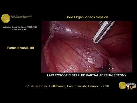 Laparoscopic left & right stapled partial adrenalectomy from the SAGES Video Library