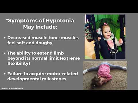 BBSOAS and Hypotonia
