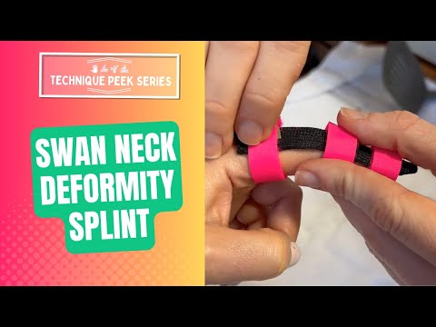 How to Create a Swan Neck Deformity Splint using Orficast | Technique Peek Series