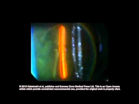 Classification of posterior vitreous detachment ID 54021 Supplementary video 3