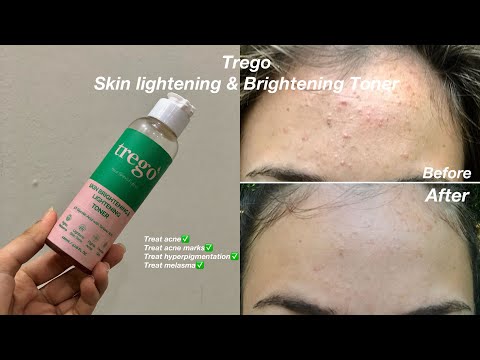 Skin Brightening & Lightening Toner||Trego Glycolic Toner "Honest Review"