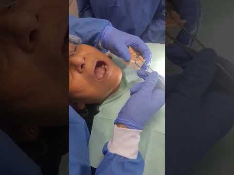 Diseño de sonrisa con corona dental en Barranquilla por la odontóloga Janette Dutrenit