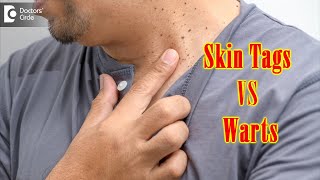 What Causes Skin Tags And Warts? | Get Rid of Warts & Skin Tags- Dr. Renuka Shetty | Doctors