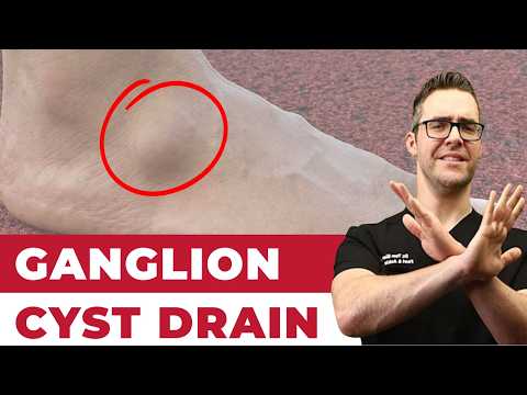 HUGE Foot PIMPLE filled with dead FAT Crystals