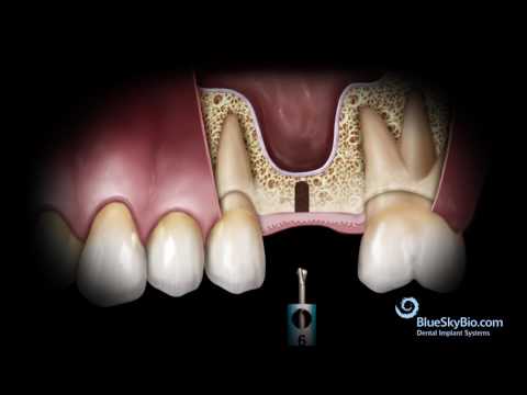 Basic Hammerless Sinus Lift Instrument Technique