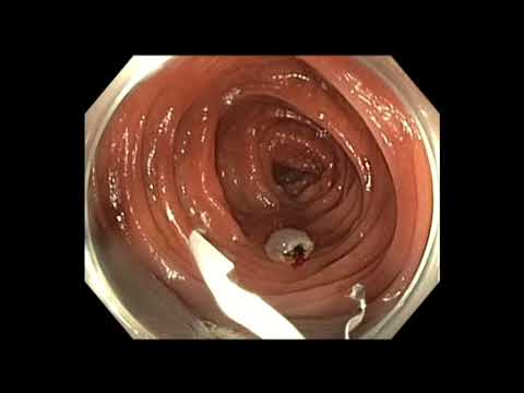 Colonoscopy: Colon Polyp with Cancer - which one needs surgery after EMR