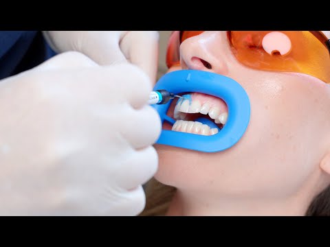 #howto fläsh In-Office Bleaching 02 von 08: Anlegen des Zahnfleischschutzes