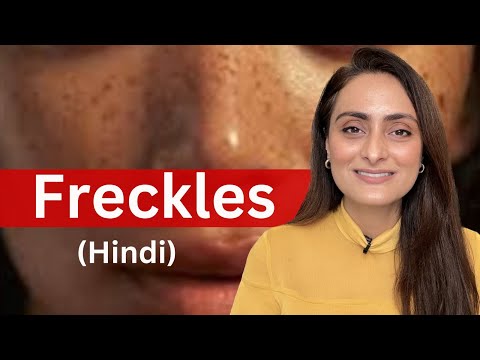 Freckles | Kyun hota hai | Kaise kam kare | serums & creams, sunscreen | Dermatologist