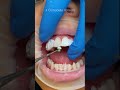 4 Composite Veneers #shorts