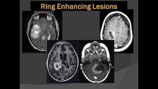 Brain Scans: Lord of the Ring Enhancing Lesions 101