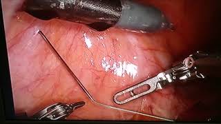 TPEA Lifter - Uterus Suspension