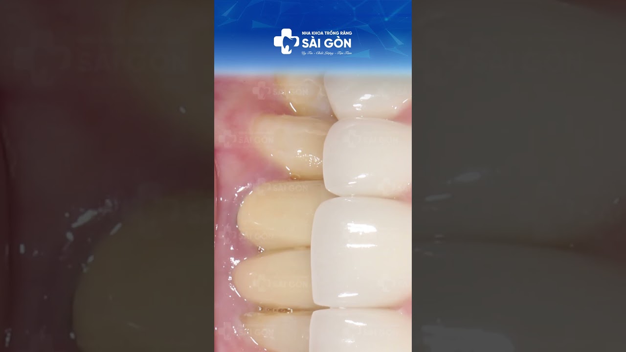 Bọc Răng Sứ - Nâng Tầm Nụ Cười Mới Bền Đẹp, Trắng Sáng Tự Nhiên | Nha Khoa Trồng Răng Sài Gòn #bọcsứ